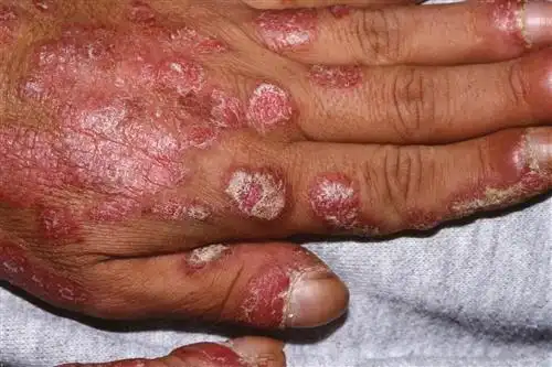 系统性红斑狼疮