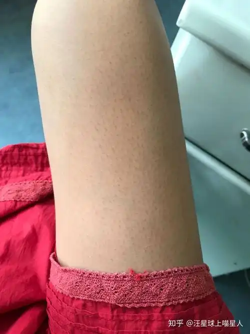 儿童鸡皮肤怎么消除最有效(儿童鸡皮肤怎么消除最有效 腿部手臂)