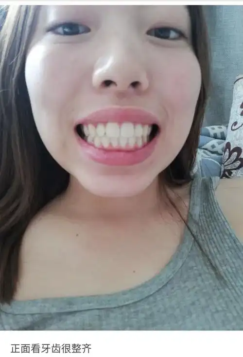 骨性龅牙正畸有没有效果-龅牙矫正-牙套之家|牙齿矫正 中国最大的牙齿