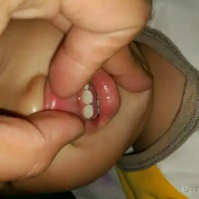 17个月宝宝牙齿有白斑,黄渍怎麼回事?