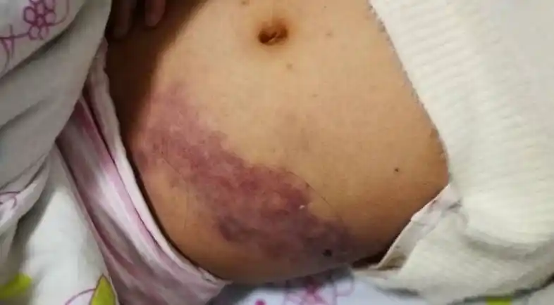 坏死性筋膜炎误诊为水痘你是否遇到过