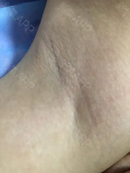 这是第二次来了,腋下得毛毛比第一次真的少了很多