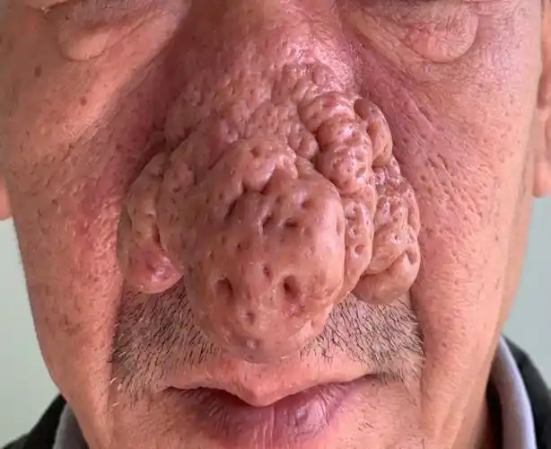 摆脱酒糟鼻不做别人眼中的小丑