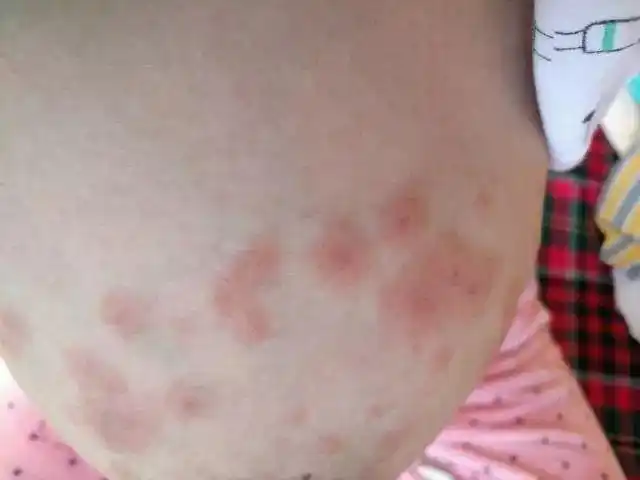 产后胸部长湿疹,还能继续哺乳吗?_乳房