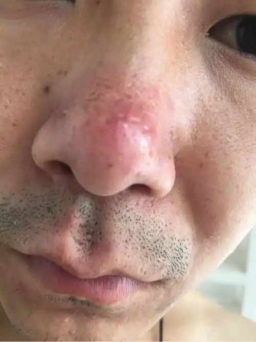 酒糟鼻医院_治疗酒糟鼻哪家医院好_治疗酒糟鼻最好的医院/排行_有来