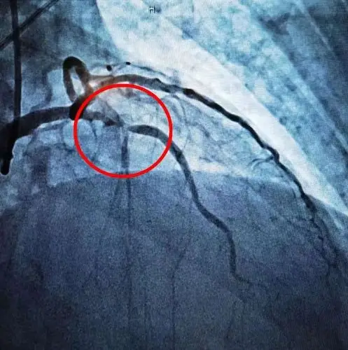 楼朝臣副主任为胡大伯行急诊经皮冠脉造影术.