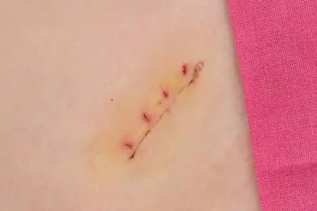 被隔绝的向量例证医学,阑尾切除术手术疤痕胖女人手术标记手臂切的