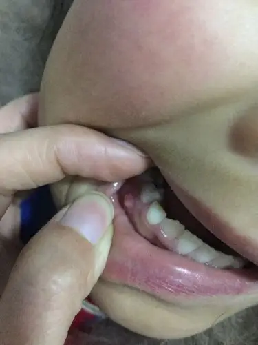 孩子八岁,牙龈里面鼓起来了,好像化脓了,吃消炎药没有消除.