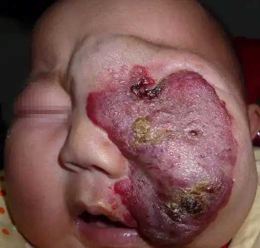 血管瘤的发病过程及治疗选择_血管瘤名医介绍 血管瘤论坛-中国血管瘤