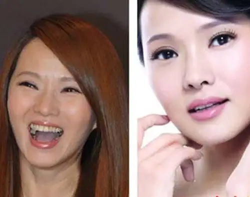 图伊能静整容前后对比照曝光自称只做过双眼皮手术