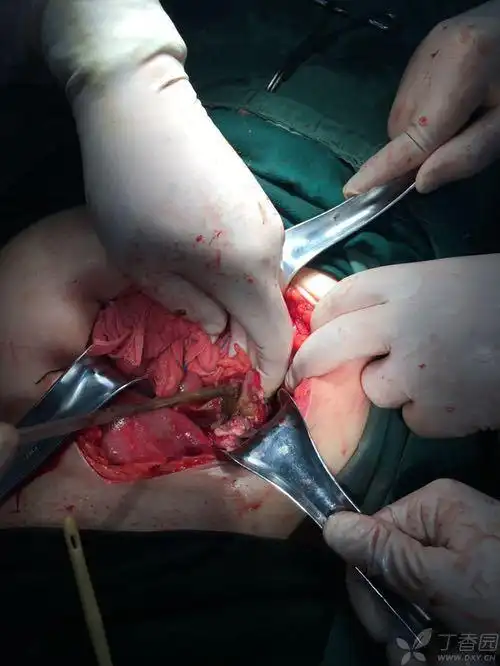 人流术中应该会发现啊 看看这两张图,上次没来得及上传