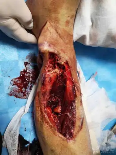 一例胫骨多段粉碎性骨折讨论