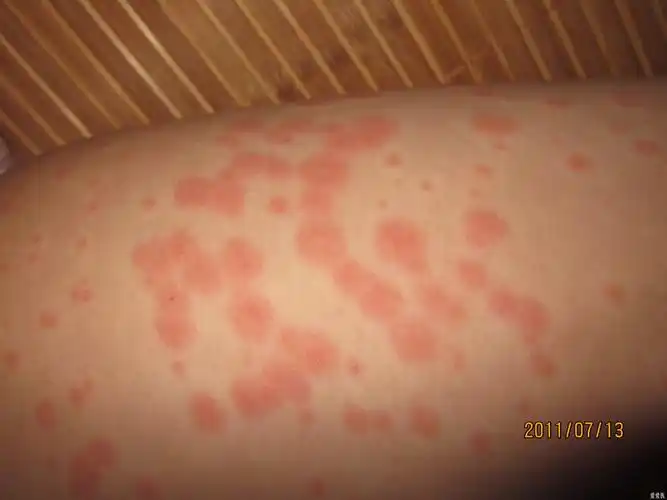 临床第三区 69 皮肤及性传播疾病讨论版 69 身上多发部位红斑