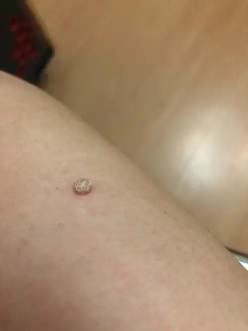 胳膊上长了个小疙瘩,不疼不痒,表面裂开