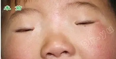 姗姗,女孩,是我科目前最小的小睑裂手术患儿,出生以后眼睛就睁不开