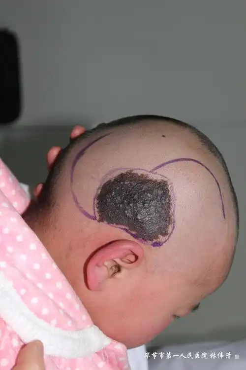 皮肤科为一4岁患儿切除头皮巨型兽皮痣