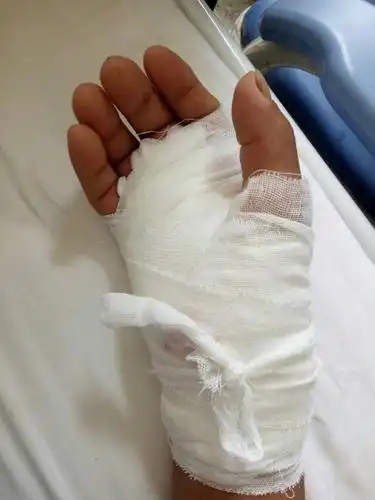 双侧腕管综合症 2.右手环指狭窄性腱鞘炎 3.双膝关节退行性变