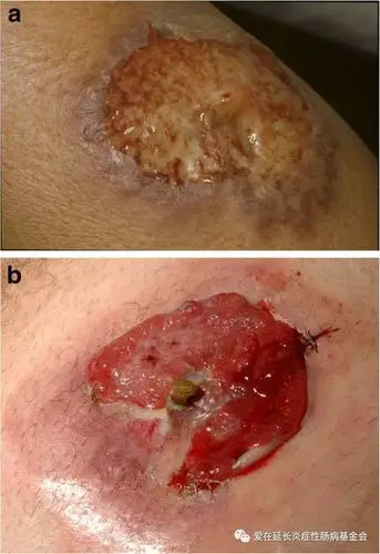 【cccf医师笔记—王强】(十四)炎症性肠病的皮肤表现