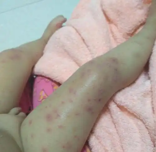 大腿上起满了疹子