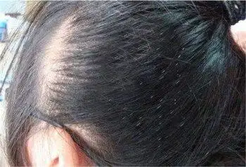 头发上的虱子卵怎么去除