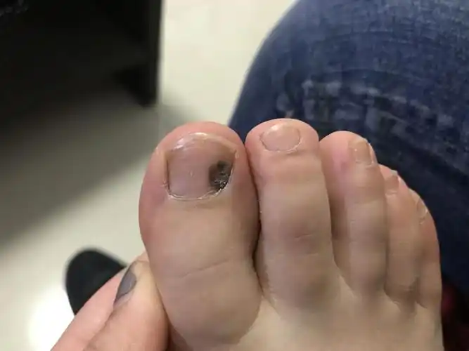 脚趾甲上长了黑黑的一块,好恐怖.