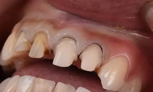 冠桥|upcera .12.11.21.22.41.31 - 睿齿美学工作室