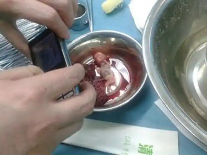 怀孕十几天流产图片_有来医生