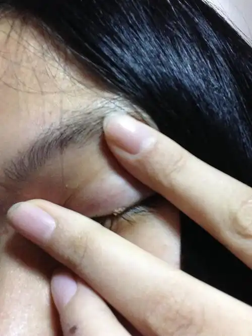 眼睛周边有类似脂肪粒的东西,一个一个小点