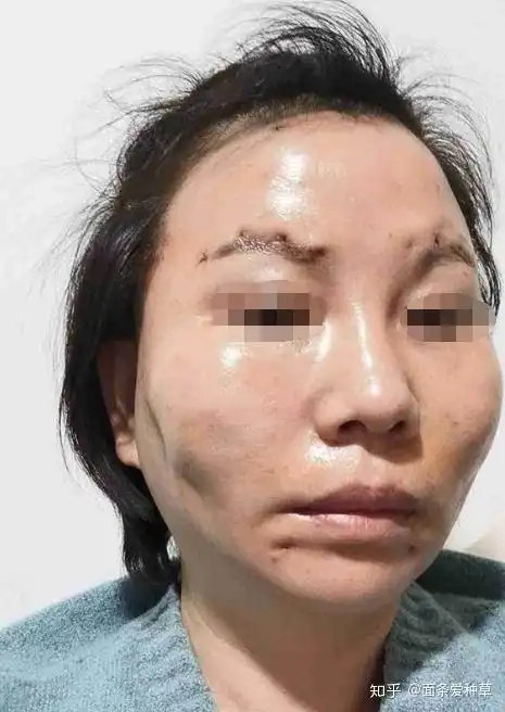 线雕埋线都有哪些后遗症