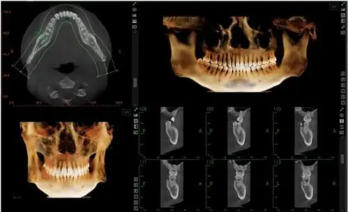 牙医520重磅发布这台有ai的口腔cbct来了