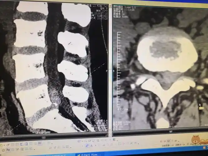 腰椎间盘ct示:l5-s1椎间盘脱出上翻,约为l5椎体的四分之三.