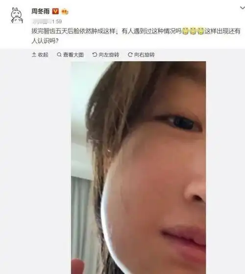 黄子韬拔智齿上热搜,这牙疼起来太痛了,究竟该不该拔?医生这样说