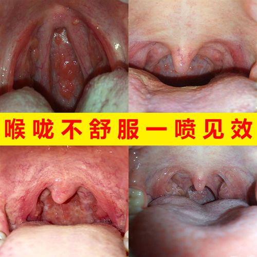 咽喉炎慢性咽炎治疗咽炎喷剂特效茶异物感喉咙肿痛茶慢性咽炎茶叶
