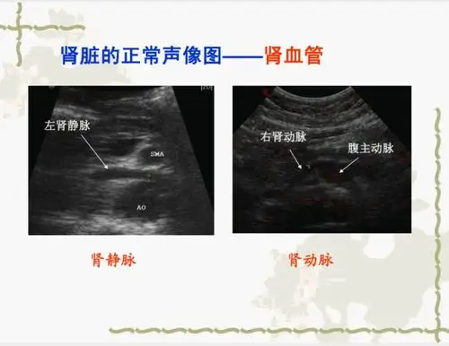 正常肾脏的超声诊断