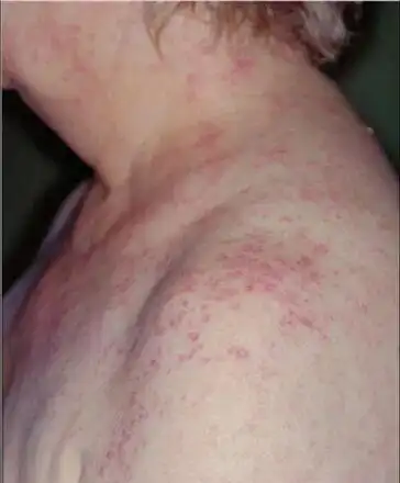 系统性红斑狼疮