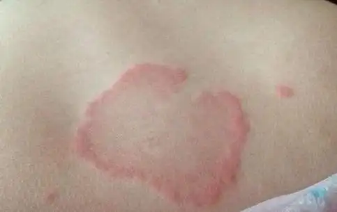 扩散到我们的全身,转移到皮肤的表面,所以如果身体出现了莫名的红斑块