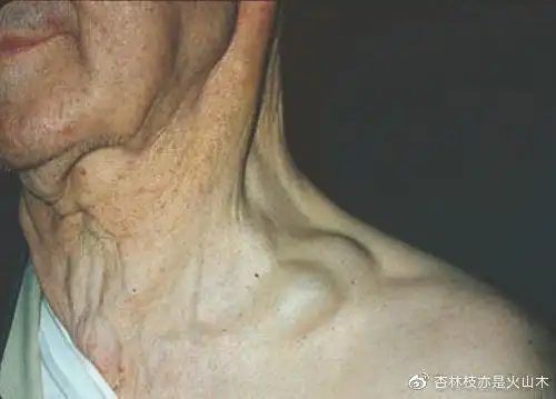 胃癌那些事之左锁骨上淋巴结