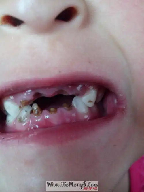 做梦梦到自己掉牙齿_做梦梦到牙齿掉光_做梦梦到牙齿烂了掉了