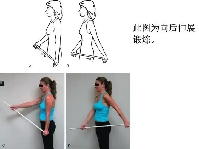 手术是一个重要步骤,术后的康复锻炼也是至关重要的,它是确保肩关节不