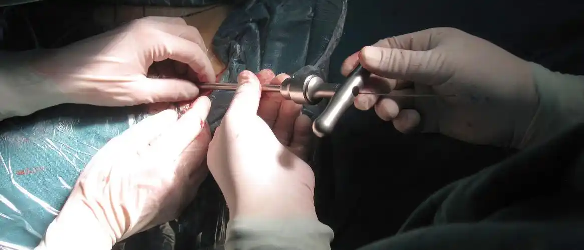 (本文部分内容来源于网络)椎间孔镜手术中钳夹取出的突出间盘(注射