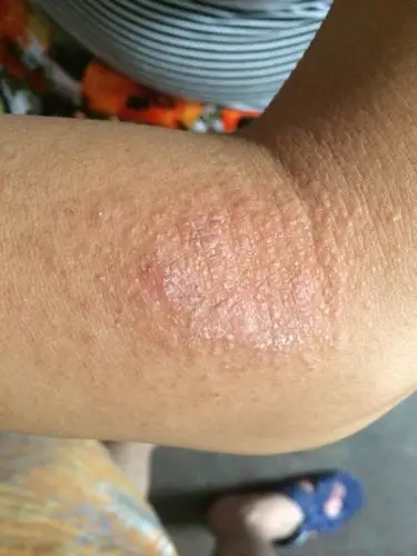 胳膊上长了一些疙瘩,特别痒,哪位帮我看看?这是什么疙瘩?怎么弄?