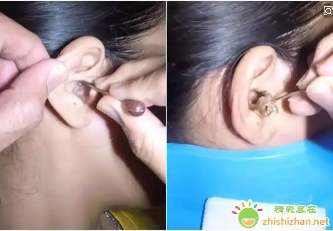 耳屎很硬很大掏不出来怎么办