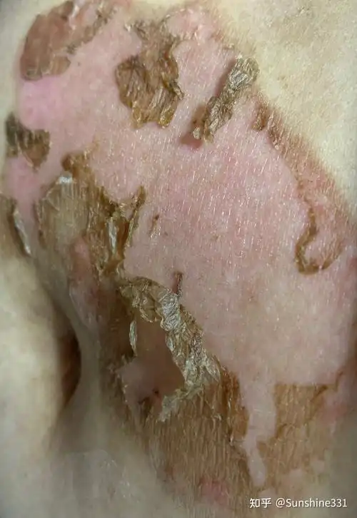 二度烫伤恢复过程记录