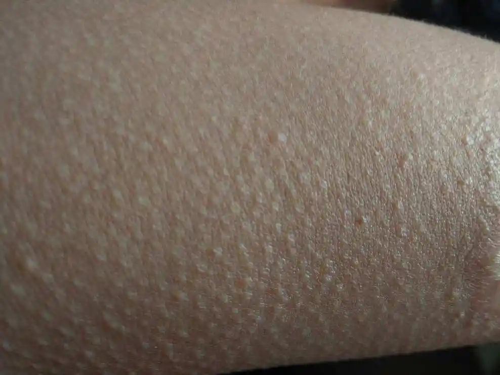 缓慢    老化角质,有用 缩短 毛孔  ,预防  皮肤苍老 ,脱皮,粗拙 干裂