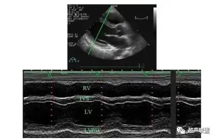 纯干货心脏超声经验分享