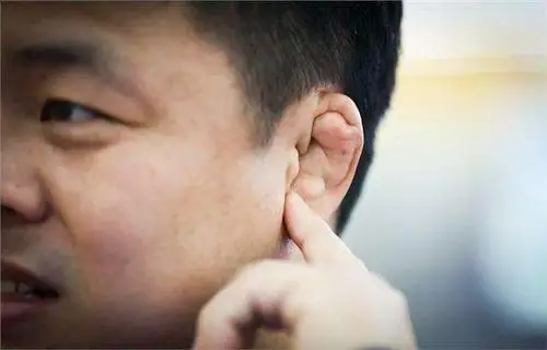 【皮肤科病例分享】耳廓畸形矫正术