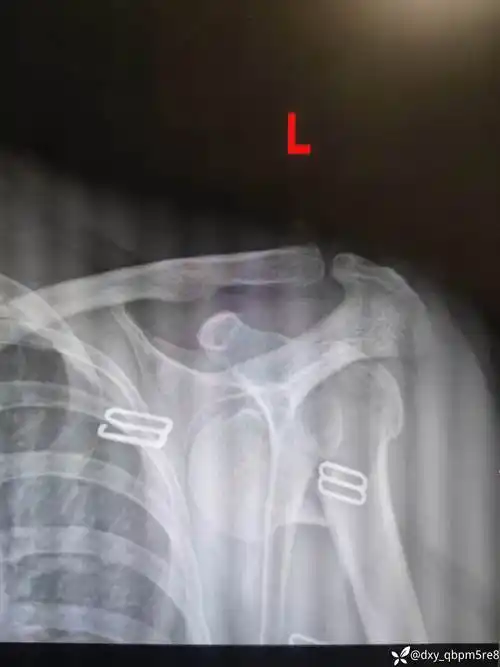 一例左肩关节脱位伴肱骨近端骨折病例