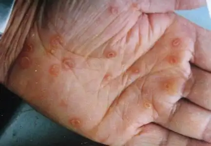 硬下疳初期图片8