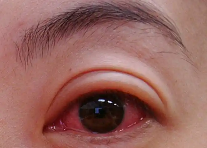 过敏性结膜炎类型多症状各有不同最常见为眼部发痒