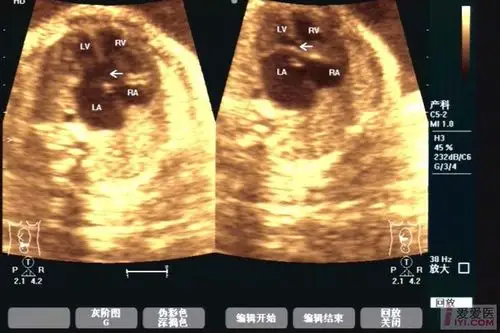 【原创】胎儿发育畸形------ 部分型心内膜垫缺损两例